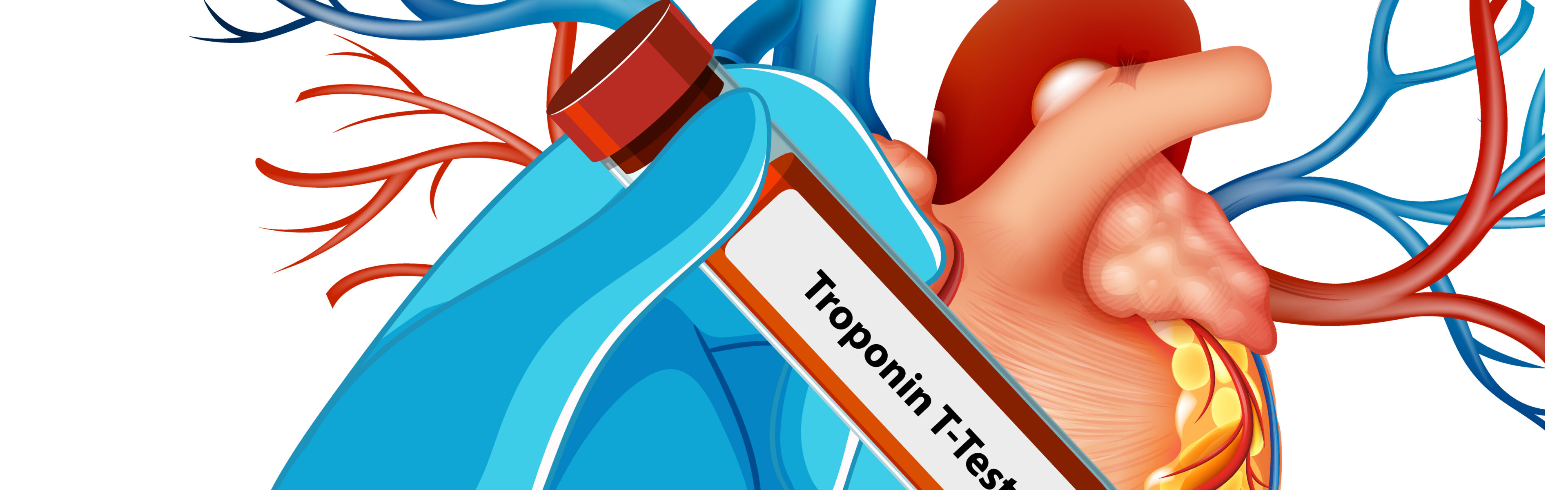 Troponin test