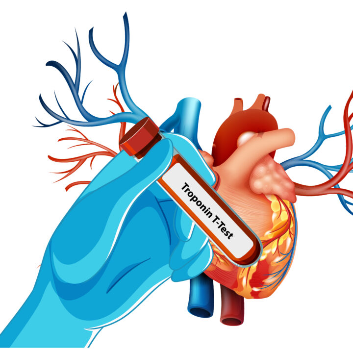 Troponin test