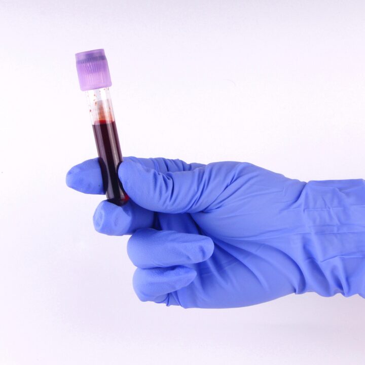beta-2 mikroglobulin