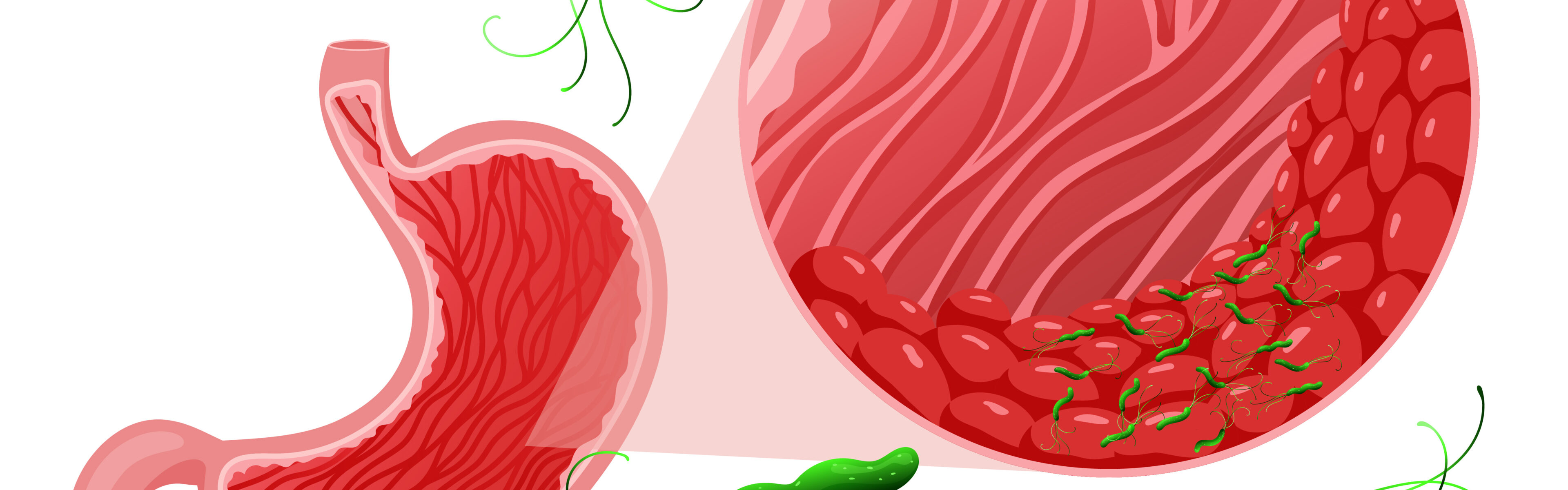 Helicobacter pylori