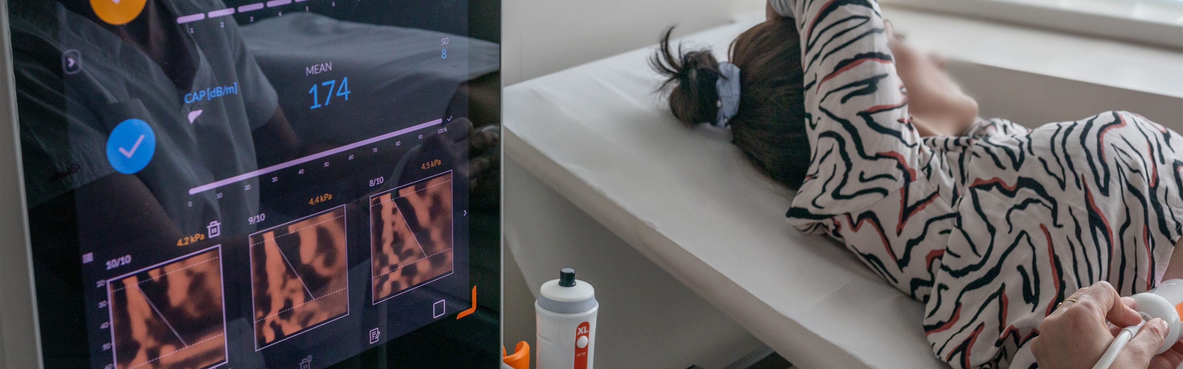 neinvazivna dijagnostika jetre fibroscan